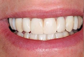 Maitland Avenue Dental | Emergency Treatment, Veneers and Dentures